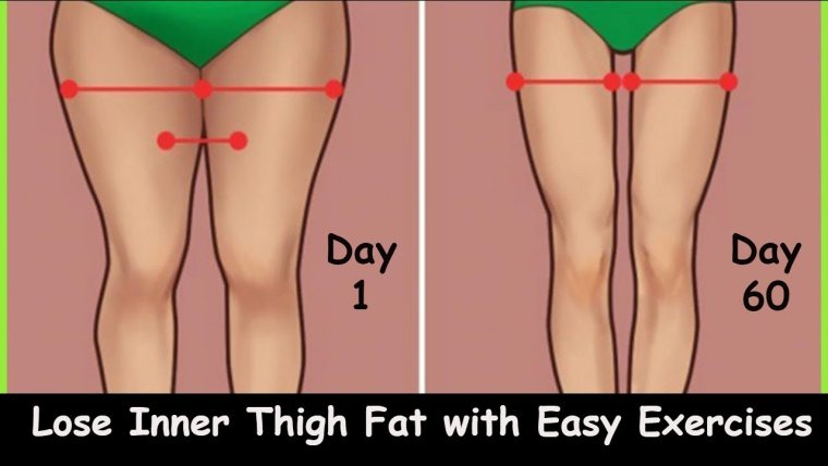 Аппарат Илизарова исправление кривизны ног