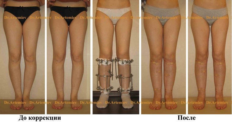 Выпрямление кривых ног