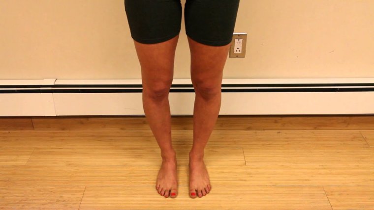 Ноги у человека в виде х