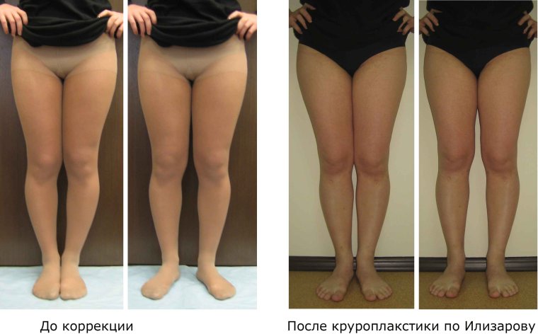 Короткие кривые ноги у женщин