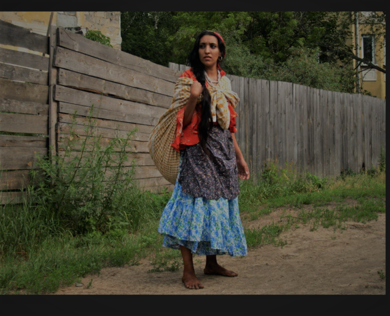 Синдром оборотня (гипертрихоз)