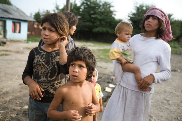 Синдром оборотня (гипертрихоз)