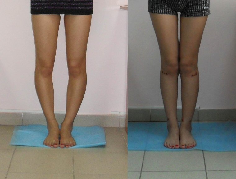 Аппарат Илизарова исправление кривизны ног