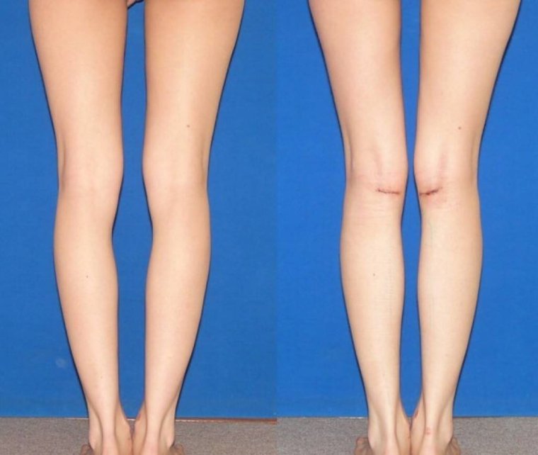 Круропластика импланты