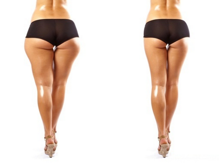 Ложная х образная кривизна ног