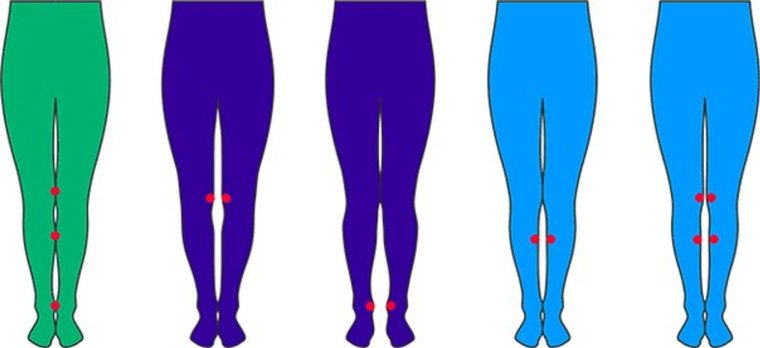 Ложное искривление ног