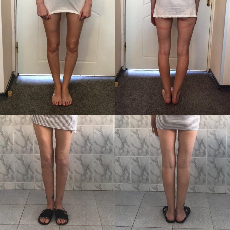 Пронация вальгус стопы