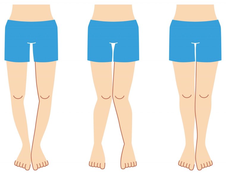 Скелет с кривыми ногами