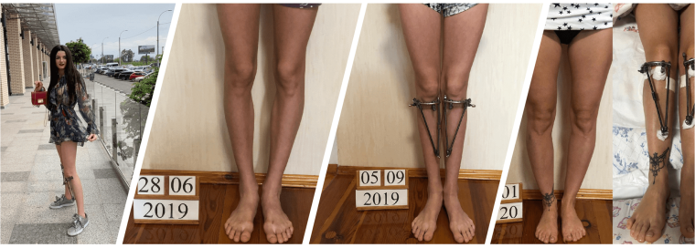 Ровные ноги