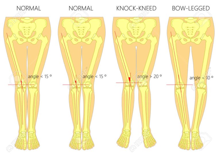 Аппарат Илизарова кривизны ног