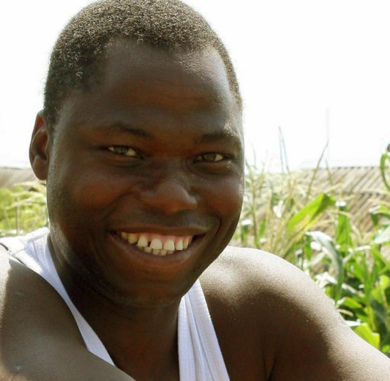 Альбинизм негроидная раса