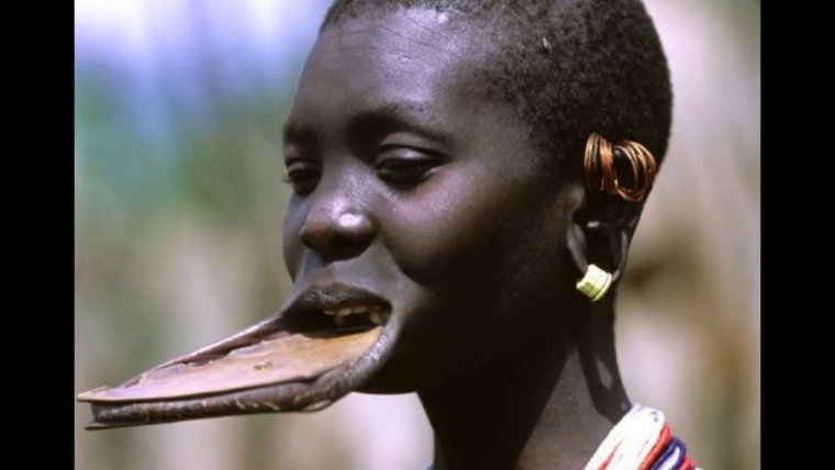 Синдром Ваарденбурга красивые люди