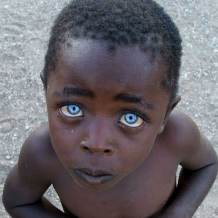 Альбинос негроидной расы