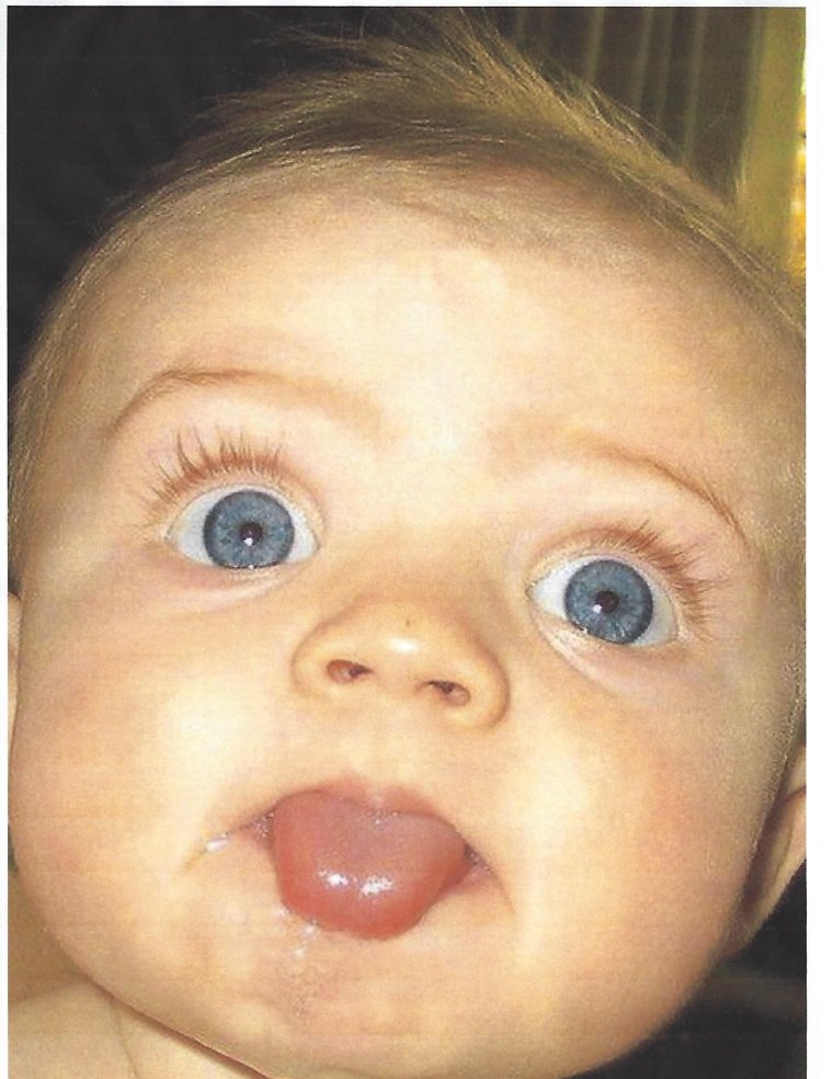 Наоми Гроссман Пеппер страдающая микроцефалией