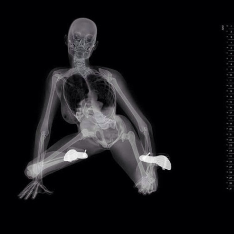 Рентген паука