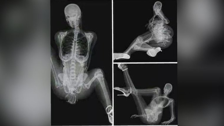 Мемы про рентген