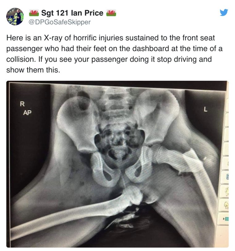 Рентген ноги на торпеде