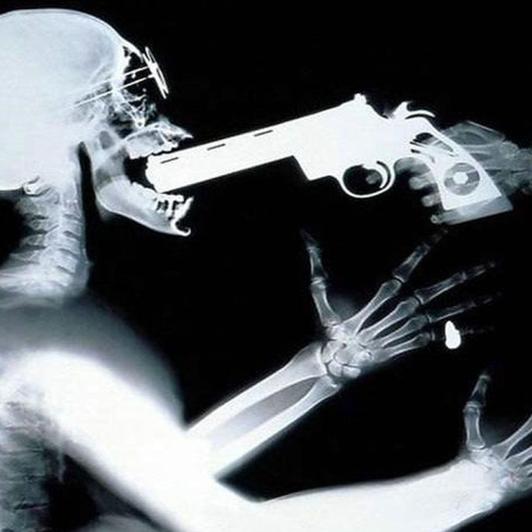 Рукожоп рентген