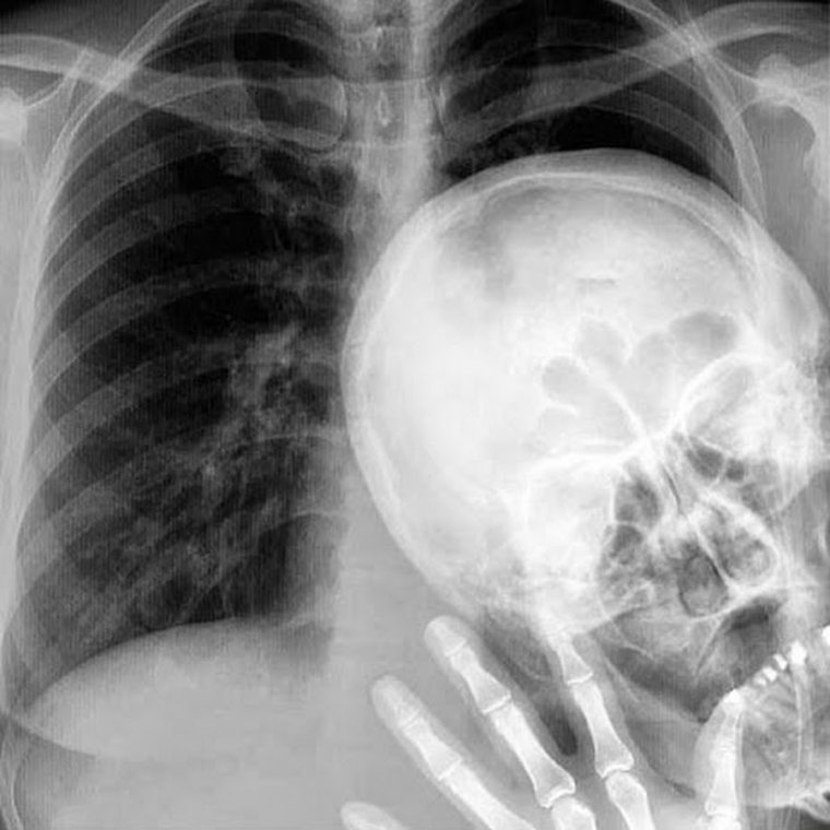 Всегда найдется друг который испортит флюорографию