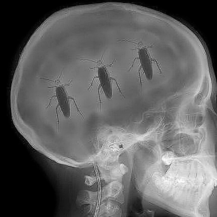 Трахе на рентгеновском снимке