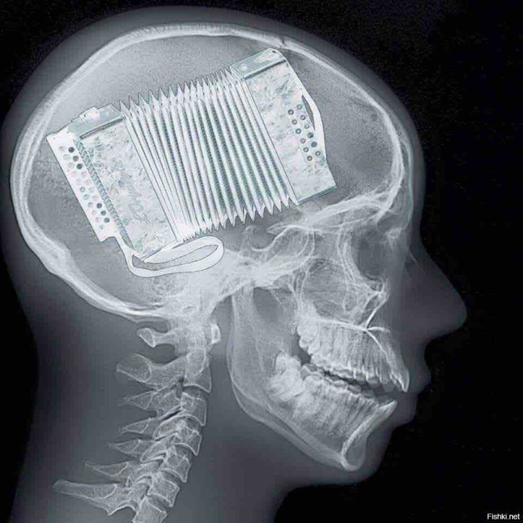 Рентген руки после петарды