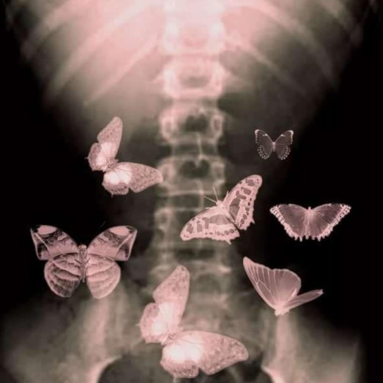 Бабочки в животе рентген