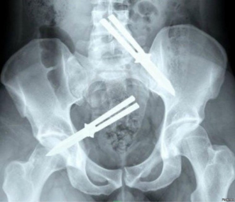 Бабочки в животе рентген