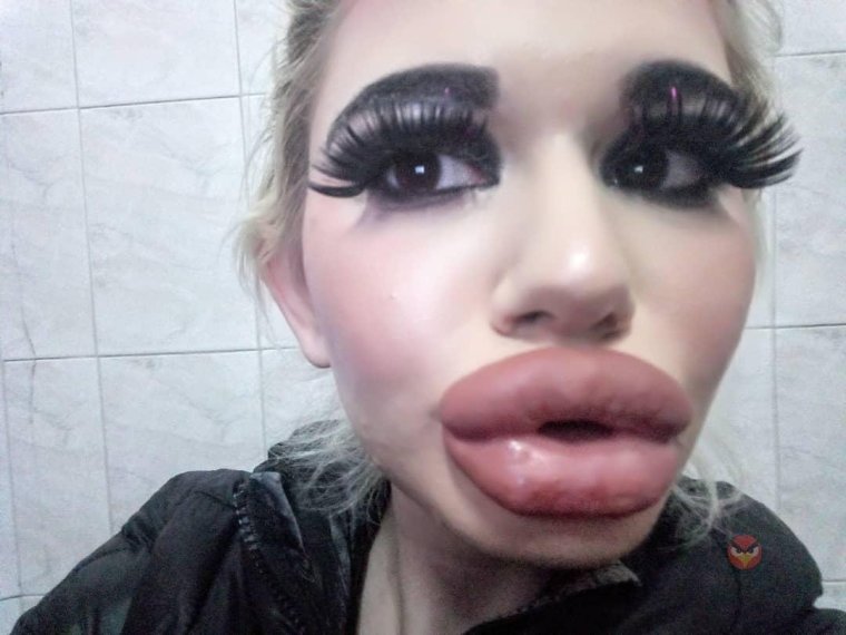 Накачанные быотексом губы