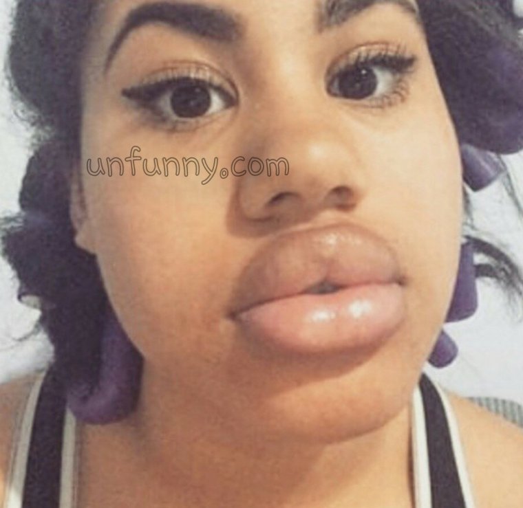 Накаченные скулы ботоксом