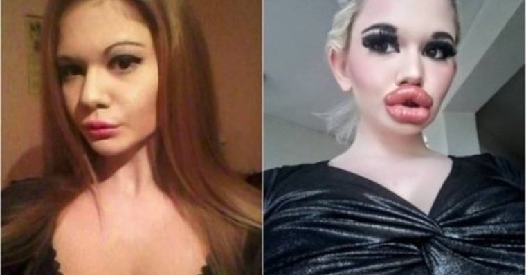 Накаченные губы