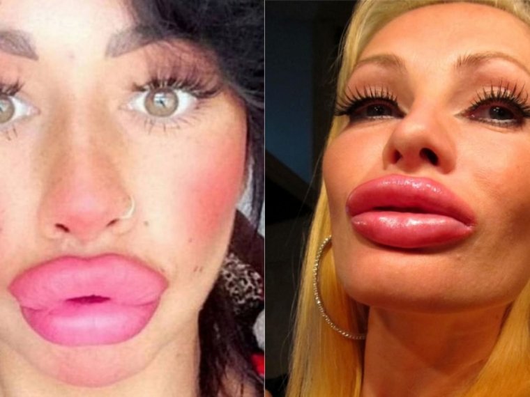 Накаченные губы до и после