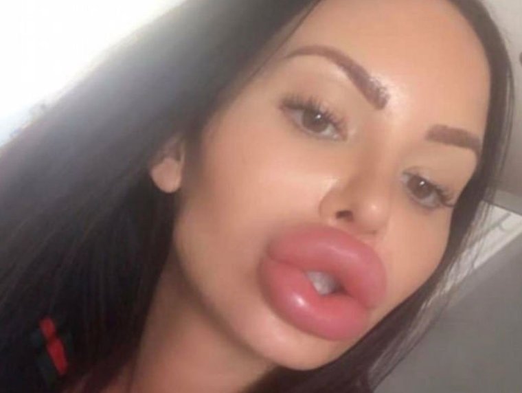 Накаченные силиконом губы