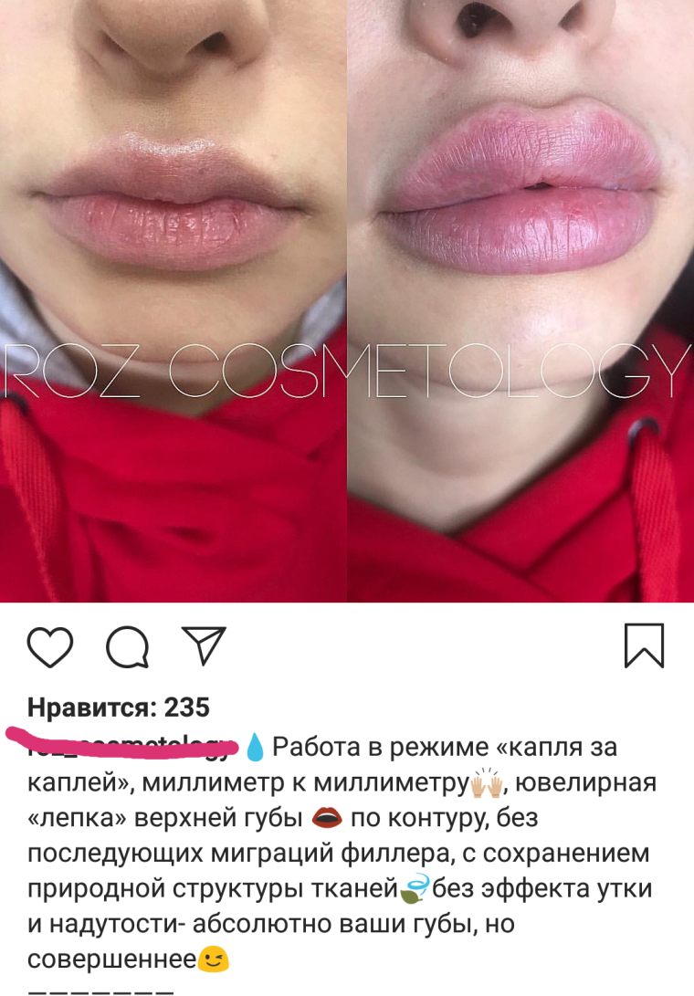 Девочки с пухлыми щеками и губами