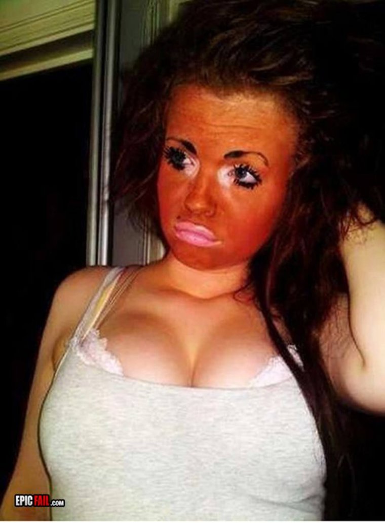 Сильно сгорел на солнце