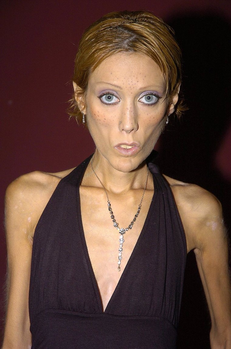 Изабель Каро анорексия