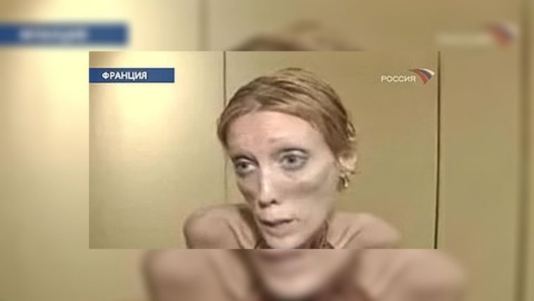 Сергей Гайсин анорексия