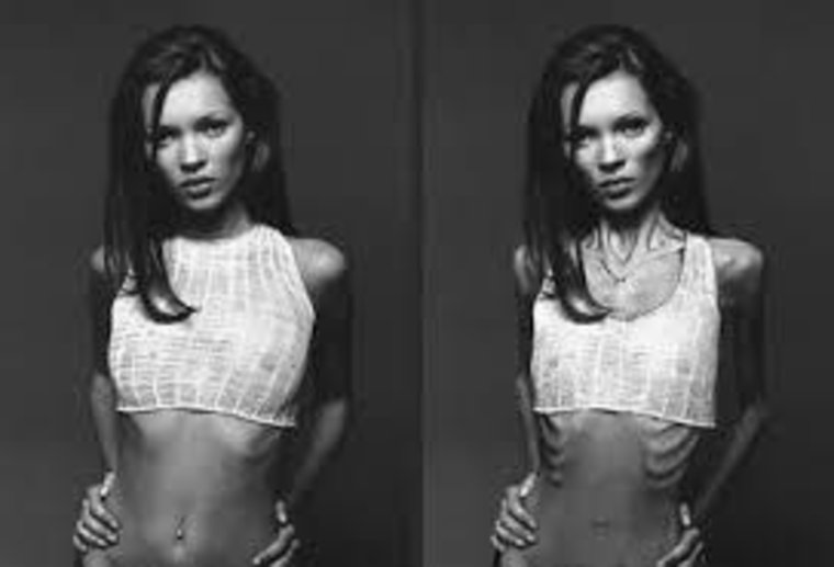 Анна Жолобова анорексия