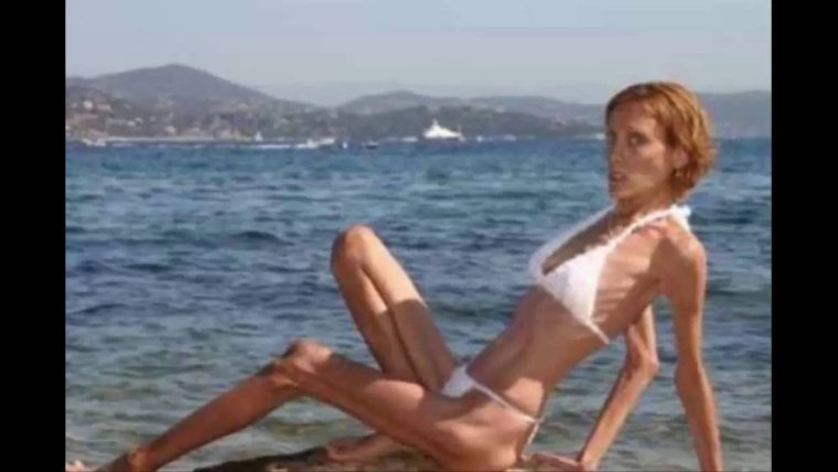 Изабель Каро анорексия