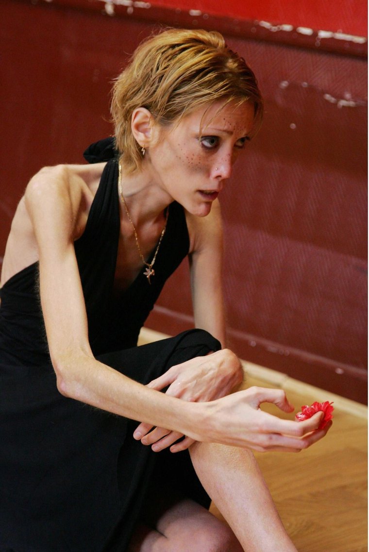 Изабель Каро анорексия