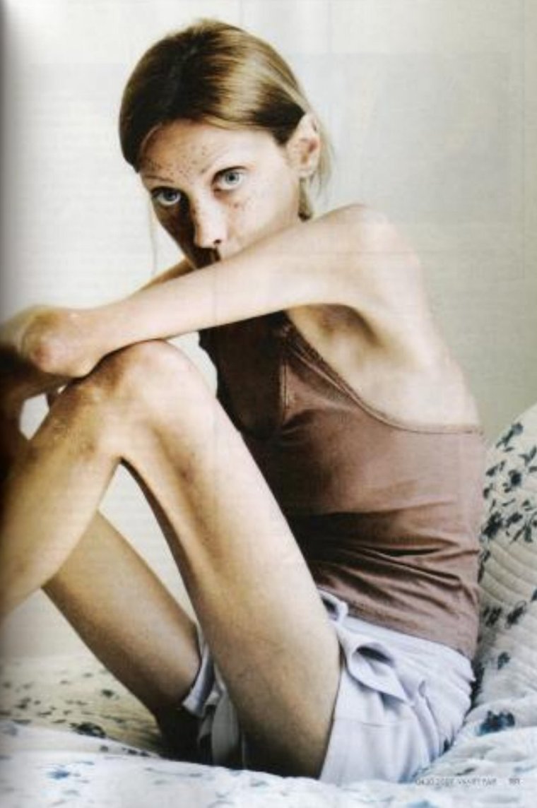 Изабель Каро анорексия