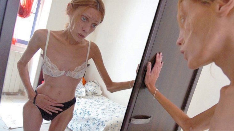 Девушка на грани анорексии