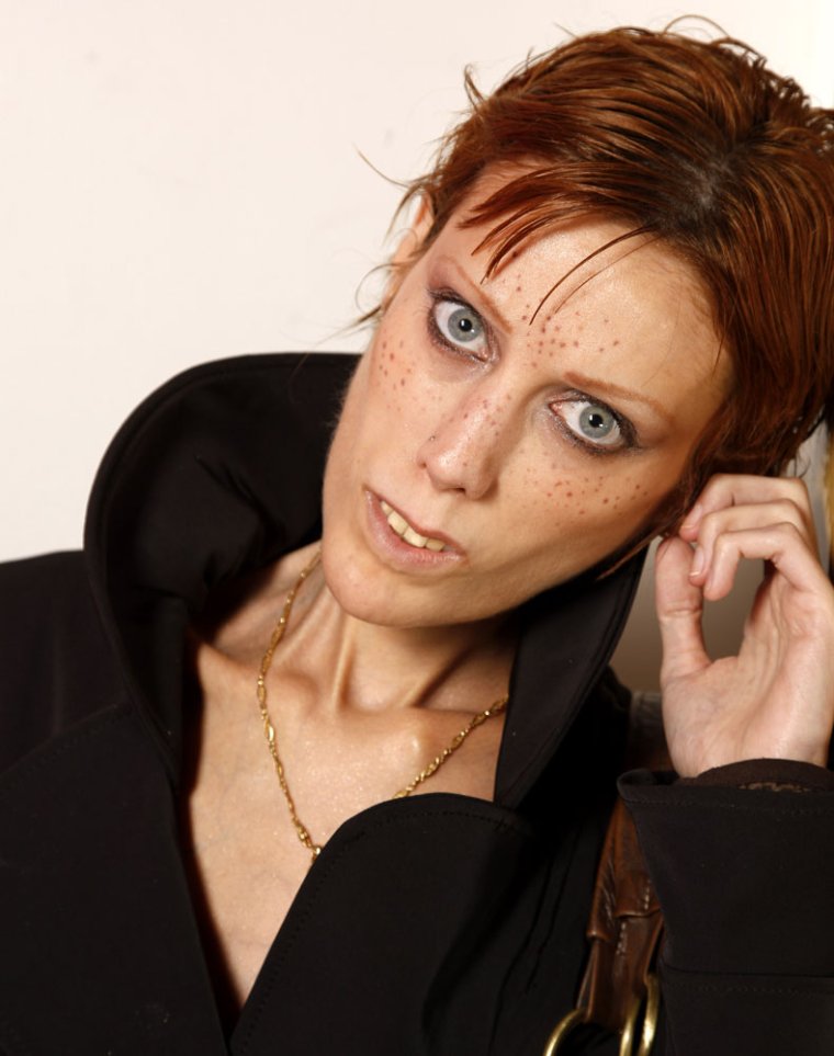 Изабель Каро анорексия