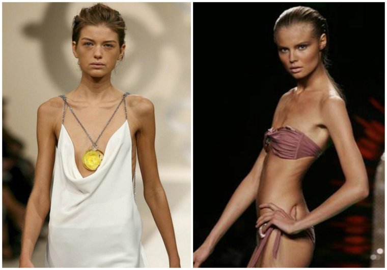 Яна Бородина анорексия