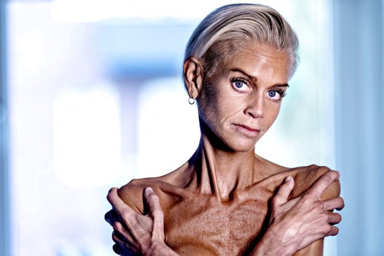 Изабель Каро анорексия