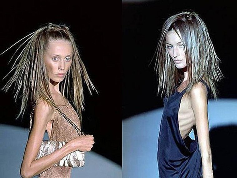 Дисморфоманическая анорексия