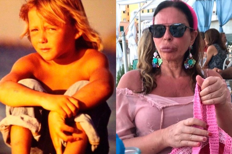 Джослин Вильденштейн до и после пластики