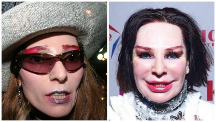 Жанна Агузарова пластика