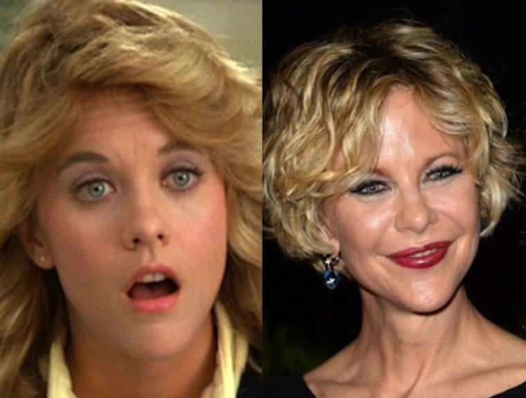 Мег Райан пластическая операция