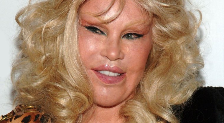 Неудачная пластика лица