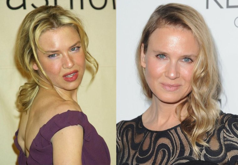 Рене Зеллвегер неудачная операция